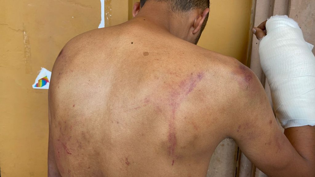 Lesiones causadas al periodista. Foto: Redes Sociales